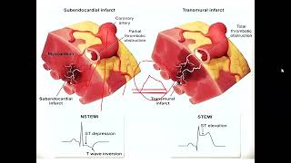 Arritmias Trastorno conducciónelectrolíticos HNGAI Angiocardiología  sem 8 [upl. by Ygief]