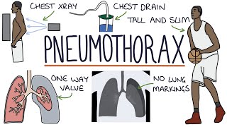 Pneumothorax [upl. by Schulein673]