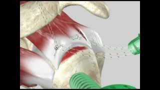 Arthroscopic Rotator Cuff Repair [upl. by Osman499]