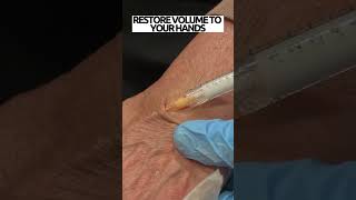 How to remove hand wrinkles  Filler injections in hands [upl. by Ahsilak]