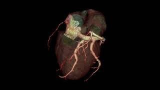 CORONARY VENOGRAM [upl. by Henry]