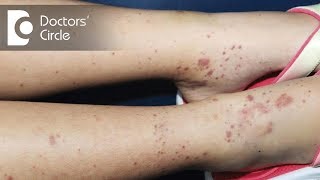 How to manage itchy skin amp small black spots on arms amp legs in 3 year old  Dr Varsha Saxena [upl. by Ettener337]