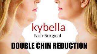 Kybella injection Double Chin Removal [upl. by Flinn]