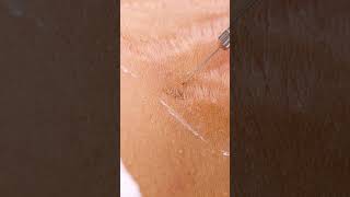 Up close view of how laser stretch mark removal works 😯 shorts [upl. by Hennessey375]