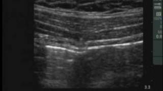 UltrasoundGuided Transversus Abdominis Plane Block [upl. by Harhay639]