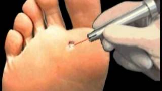 Plantar Wart Laser Treatment  Institute Beaute New York [upl. by Panta]