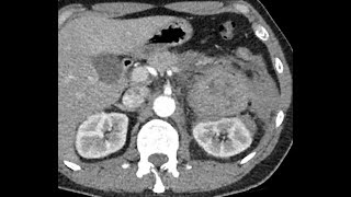 Pheochromocytoma bleeding  Life Threatening condition  Beware [upl. by January974]