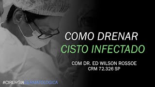 COMO DRENAR CISTO INFECTADO  DR ED WILSON ROSSOE  CIRURGIA DERMATOLÓGICA [upl. by Ahsenak614]