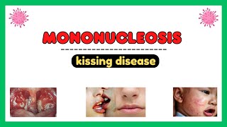 Mononucleosis infection epstein barr virus pathophysiology symptoms diagnosis treatment [upl. by Judson]