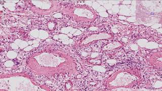 Angiomyolipoma  Kidney Histopathology [upl. by Emily426]