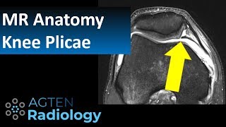 MRI Anatomy of Knee Plicae [upl. by Eatnahs]