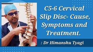 C5  C6 Cervical Slip Disc Cause Symptoms and Treatment [upl. by Howey546]