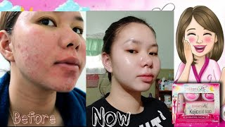 15 Days Using BRILLIANT SKIN ESSENTIAL ✅ REJUVENATING SET REVIEW [upl. by Ahsimal653]