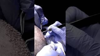 Best Hair Transplant Results in Miami  Care4Hair [upl. by Arick776]