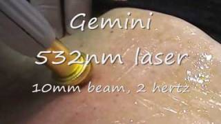 Gemini 532 nm laserwmv [upl. by Erdeid]