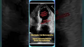 Takotsubo Cardiomyopathy Echo REBELEM FOAMus MedEd TakotsuboCardioMyopathy [upl. by Kynan]