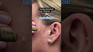 Freezing Seborrheic Keratosis with Liquid Nitrogen [upl. by Nairim218]