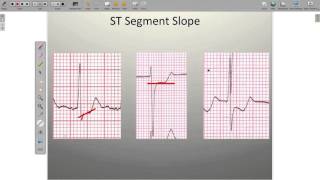 Effects of Ischemia on the ECG [upl. by Hedges]