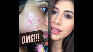 The secret to my clear skin  Malvika Sitlani [upl. by Lorien]