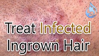 How to Treat Infected Ingrown Hair [upl. by Toor804]