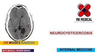 Neurocysticercosis [upl. by Witt]