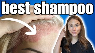 BEST Shampoo For Psoriasis  Dermatologist Recommended [upl. by Spalla584]