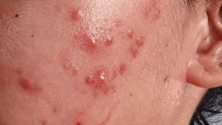 Documentation 18 Timelapse Hormonal Acne Breakouts ewww [upl. by Rusel]