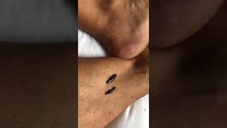 Leg amp Ankle Leech Therapy procedure Medical leeches 4 diabetes varicose veins leg thigh pressure [upl. by Veriee848]