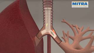 Tracheobronchial quotYquot stent MITRA OTTOMED ENDOSCOPY Interventional Pulmonology [upl. by Nancee93]