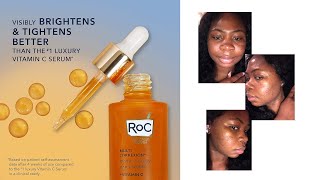 30 DAYS on roc vitamin C serum [upl. by Arlyn]