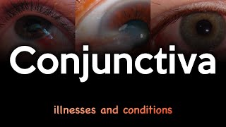 Conjunctiva Illnesses and Conditions [upl. by Sanjay84]