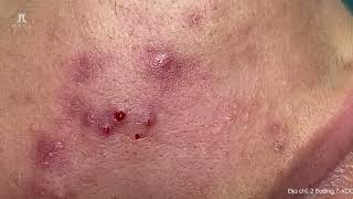 Big Cystic Acne Blackheads Extraction Blackheads amp Milia Whiteheads Removal Pimple Popping [upl. by Sabina]