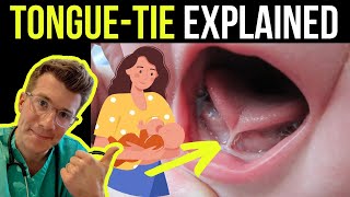 Doctor explains tongue tie in babies ankyloglossia  including treatment options [upl. by Midan287]