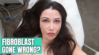 FIBROBLAST TREATMENT GONE WRONG [upl. by Marleen]