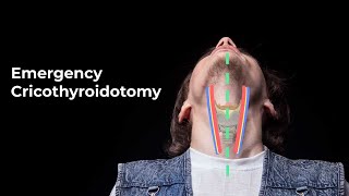 Performing an Emergent Cricothyroidotomy  MEDZCOOL [upl. by Jilli529]