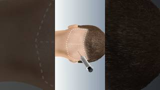 FUE Hair Transplant Have you had any experience with this procedure [upl. by Imre]