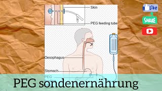 Hören B1B2 Pflege PEG Sondenernährung [upl. by Llatsyrk]