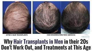 Why Hair Transplants for Men in Their 20s Dont Work Out and Restoration Treatments at This Age [upl. by Ahsekin]