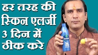 स्किन एलर्जी का घरेलू नुस्खा How To Cure Skin Allergy  skin allergy treatment at home Sachin Goyal [upl. by Yrahcaz71]