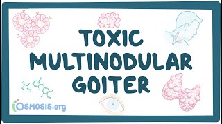 Toxic multinodular goiter  causes symptoms diagnosis treatment pathology [upl. by Housum]