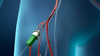 Coronary Angioplasty Femoral Access [upl. by Concha]