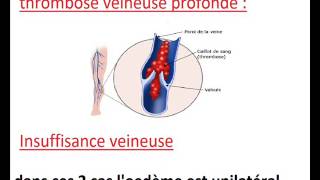 oedème des membres inférieurs [upl. by Sethi416]