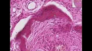 Histopathology BoneFibrous dysplasia [upl. by Gillan]