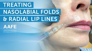 Treating Nasolabial Folds and Radial Lip Lines With Volbella [upl. by Tonjes620]