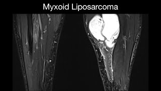 Myxoid Liposarcoma [upl. by Lesli]