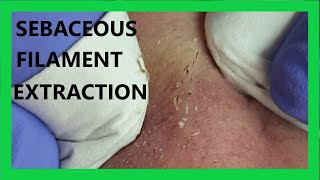 Sebaceous FILAMENT Extraction [upl. by Nomael579]