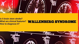 wallenberg syndrome  wallenberg syndrome mnemonic [upl. by Eednyl]