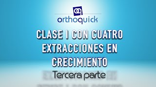 CLASE I CON CUATRO EXTRACCIONES EN CRECIMIENTO TERCERA PARTE [upl. by Retepnhoj493]