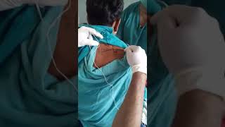 SUPRASCAPULAR NERVE BLOCK PNS GUIDED [upl. by Edaj]