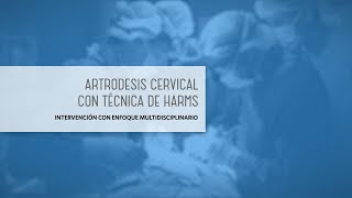 Artrodesis Cervical con Técnica de Harms [upl. by Jolenta417]